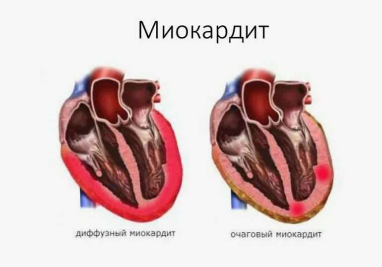Диагностика и лечение миокардита у взрослых