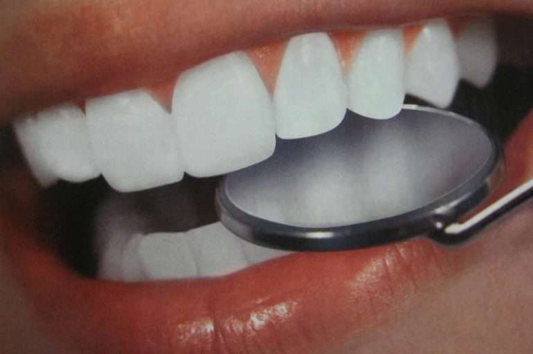 Внутрикоронковое отбеливание: что нужно знать перед процедурой