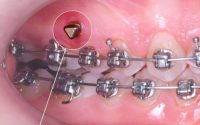 Ретейнеры и мини-импланты: как сохранить результат лечения и восстановить зубной ряд