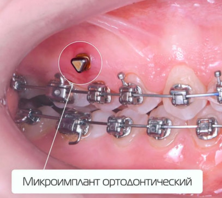 Ретейнеры и мини-импланты: как сохранить результат лечения и восстановить зубной ряд