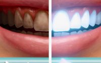 Когда нужно отбеливание зубов