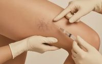 Склеротерапия вен: как проходит процедура