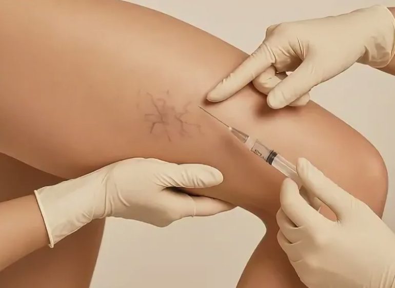 Склеротерапия вен: как проходит процедура