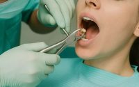 Когда удаление зуба необходимо? Показания и альтернативы